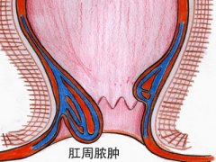 肛周脓肿有哪些症状呢?